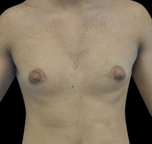 New Jersey Gynecomastia Before & After Gallery - Patient 55432625 - Image 1