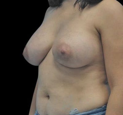 New Jersey Breast Augmentation Before & After Gallery - Patient 55432638 - Image 6