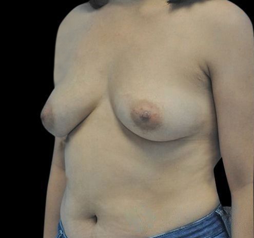 New Jersey Breast Augmentation Before & After Gallery - Patient 55432638 - Image 5