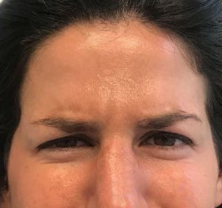New Jersey BOTOX® Before & After Gallery - Patient 55434436 - Image 2