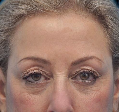 New Jersey Eyelid Surgery (Blepharoplasty) Before & After Gallery - Patient 55432552 - Image 1