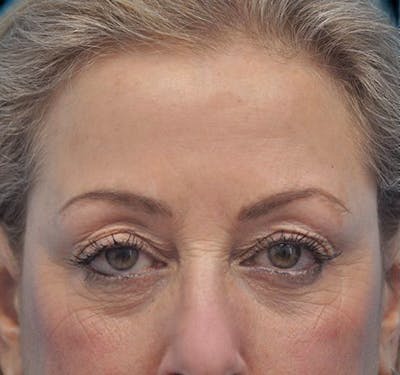 New Jersey Eyelid Surgery (Blepharoplasty) Before & After Gallery - Patient 55432552 - Image 1