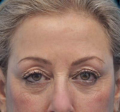 Eyelid Surgery (Blepharoplasty) Before & After Gallery - Patient 55432552 - Image 1