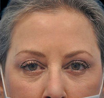 Eyelid Surgery (Blepharoplasty) Before & After Gallery - Patient 55432552 - Image 2