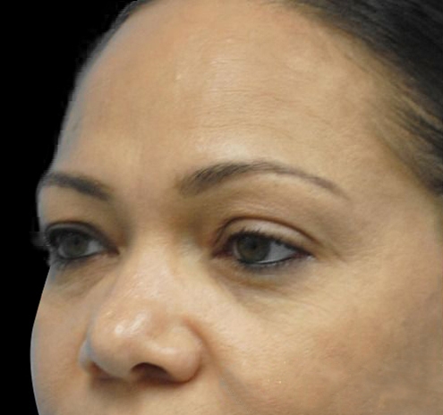New Jersey Eyelid Surgery (Blepharoplasty) Before & After Gallery - Patient 55432551 - Image 7