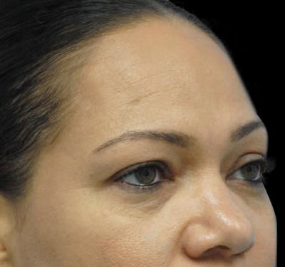 New Jersey Eyelid Surgery (Blepharoplasty) Before & After Gallery - Patient 55432551 - Image 5