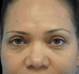 New Jersey Eyelid Surgery (Blepharoplasty) Before & After Gallery - Patient 55432551 - Image 2