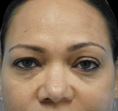 Eyelid Surgery (Blepharoplasty) Before & After Gallery - Patient 55432551 - Image 1