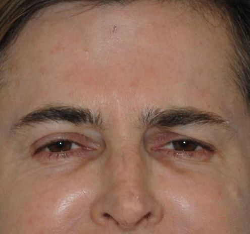 BOTOX® Before & After Gallery - Patient 55432580 - Image 2