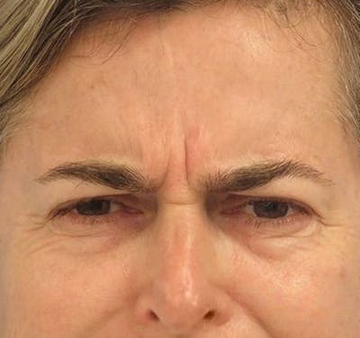 BOTOX® Before & After Gallery - Patient 55435281 - Image 1