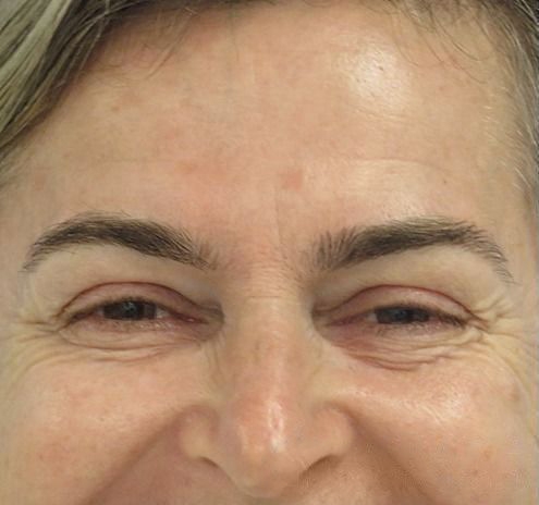 New Jersey BOTOX® Before & After Gallery - Patient 55435281 - Image 3