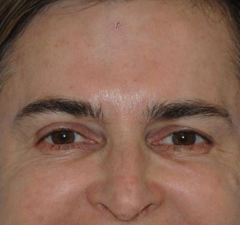 BOTOX® Before & After Gallery - Patient 55432580 - Image 4