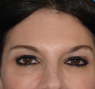 New Jersey BOTOX® Before & After Gallery - Patient 55432581 - Image 2