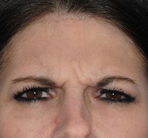 New Jersey BOTOX® Before & After Gallery - Patient 55435363 - Image 3