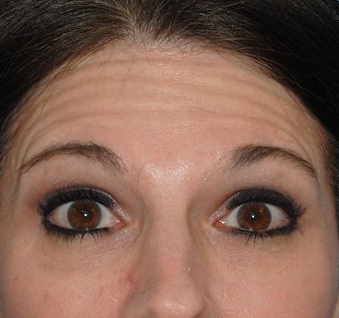 New Jersey BOTOX® Before & After Gallery - Patient 55435363 - Image 1