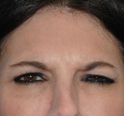 BOTOX® Before & After Gallery - Patient 55435363 - Image 4