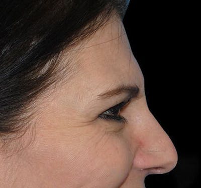 BOTOX® Before & After Gallery - Patient 55435363 - Image 5