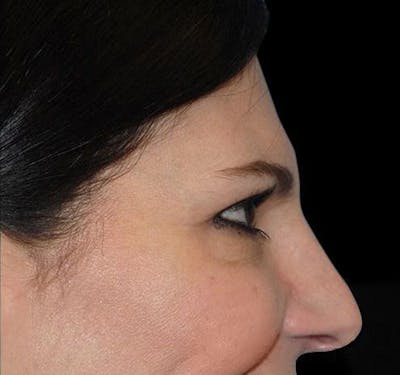 New Jersey BOTOX® Before & After Gallery - Patient 55435363 - Image 6