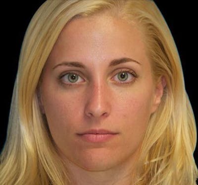 New Jersey Rhinoplasty Before & After Gallery - Patient 55432565 - Image 2