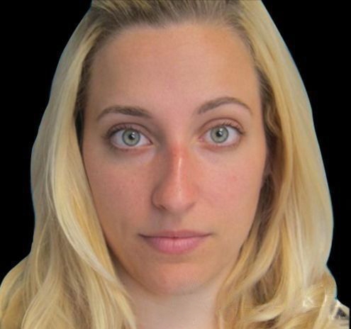 Rhinoplasty Before & After Gallery - Patient 55432565 - Image 1