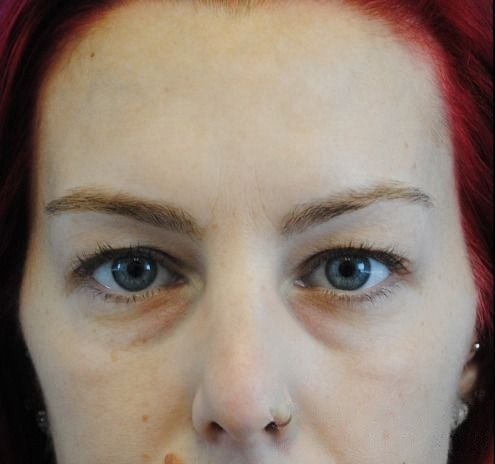 New Jersey Fillers Before & After Gallery - Patient 55436453 - Image 1