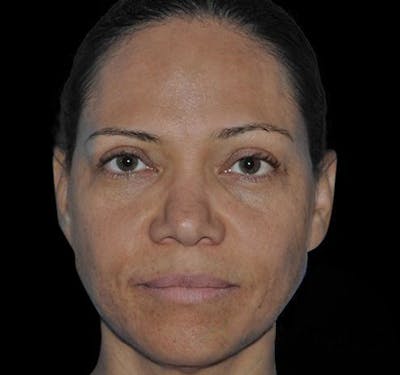 New Jersey Fillers Before & After Gallery - Patient 55436231 - Image 1