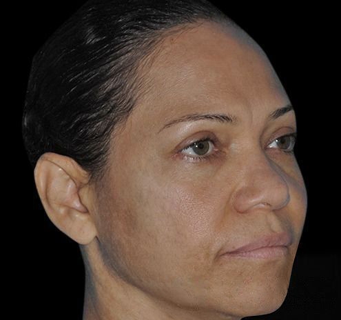 New Jersey Fillers Before & After Gallery - Patient 55436231 - Image 3