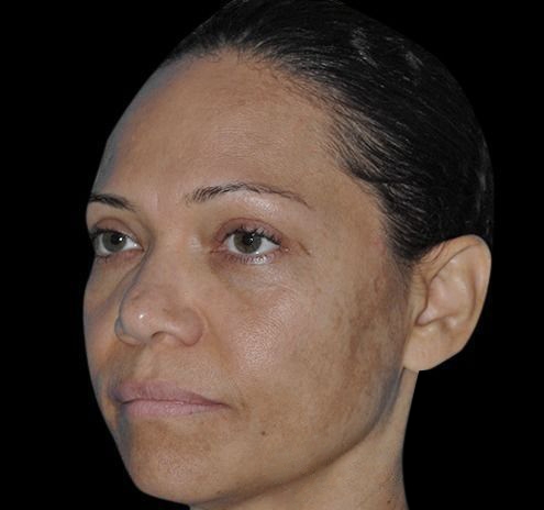 New Jersey Fillers Before & After Gallery - Patient 55436231 - Image 5
