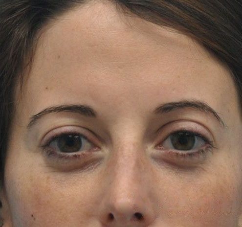 Fillers Before & After Gallery - Patient 55432590 - Image 2