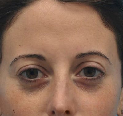 New Jersey Fillers Before & After Gallery - Patient 55436560 - Image 1