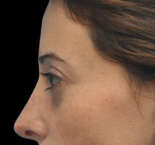 New Jersey Fillers Before & After Gallery - Patient 55436560 - Image 3