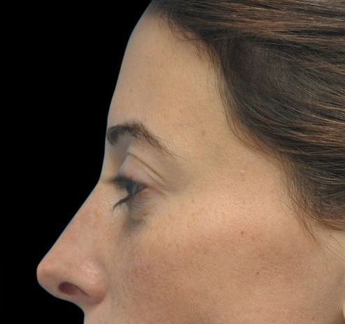 Fillers Before & After Gallery - Patient 55432590 - Image 6