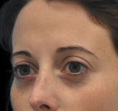 Fillers Before & After Gallery - Patient 55436560 - Image 5