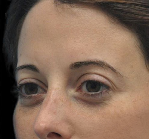 Fillers Before & After Gallery - Patient 55432590 - Image 8