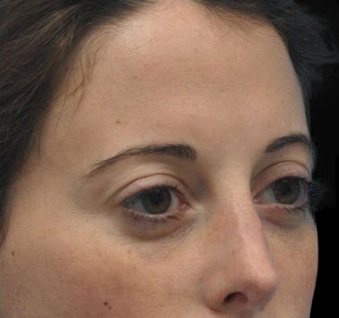 New Jersey Fillers Before & After Gallery - Patient 55436560 - Image 8