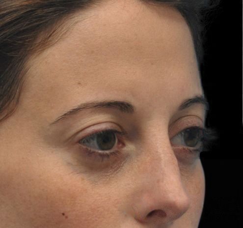 New Jersey Fillers Before & After Gallery - Patient 55436560 - Image 7