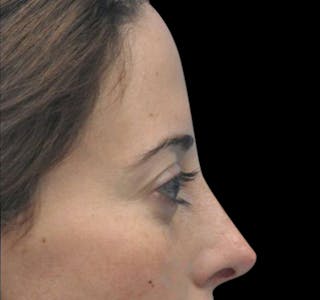 New Jersey Fillers Before & After Gallery - Patient 55436560 - Image 10