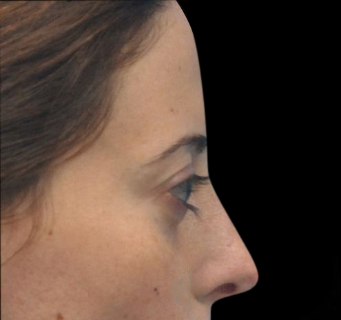 New Jersey Fillers Before & After Gallery - Patient 55436560 - Image 9