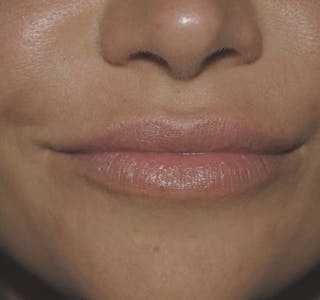 Fillers Before & After Gallery - Patient 55432584 - Image 2