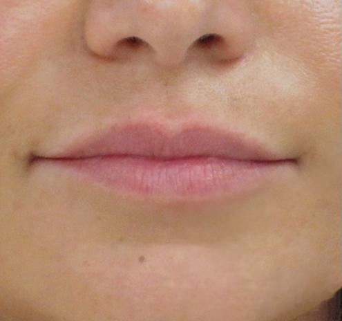 New Jersey Fillers Before & After Gallery - Patient 55436064 - Image 1