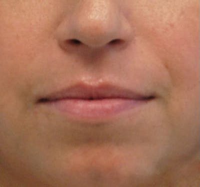 New Jersey Fillers Before & After Gallery - Patient 55436123 - Image 1