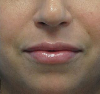 New Jersey Fillers Before & After Gallery - Patient 55436123 - Image 2