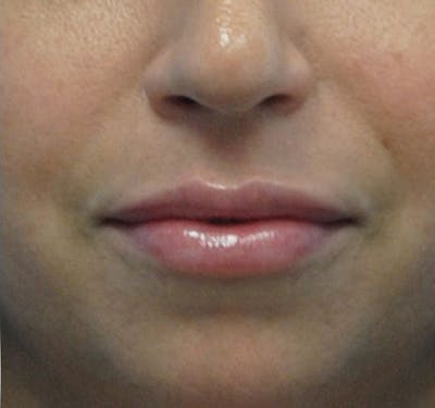 Fillers Before & After Gallery - Patient 55436123 - Image 2
