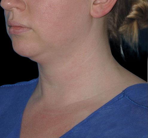 Facial Liposuction Before & After Gallery - Patient 55437783 - Image 5