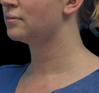 Facial Liposuction Before & After Gallery - Patient 55432562 - Image 6