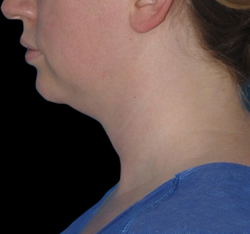 New Jersey Facial Liposuction Before & After Gallery - Patient 55437783 - Image 9