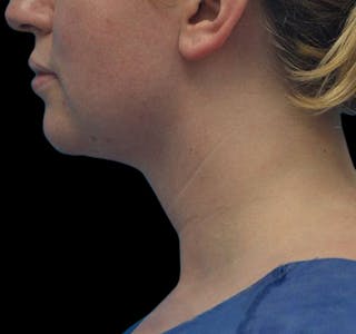 New Jersey Liposuction Before & After Gallery - Patient 55437783 - Image 10