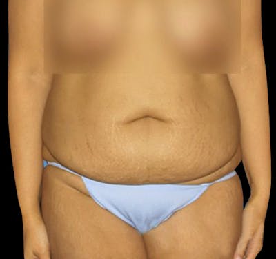 New Jersey Tummy Tuck Before & After Gallery - Patient 55432699 - Image 1