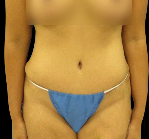 Tummy Tuck Before & After Gallery - Patient 55432699 - Image 2