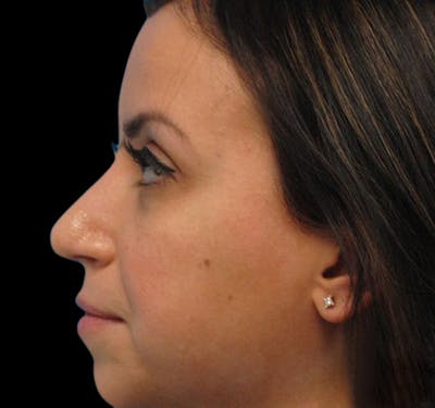 Non-Surgical Rhinoplasty Before & After Gallery - Patient 55432569 - Image 2